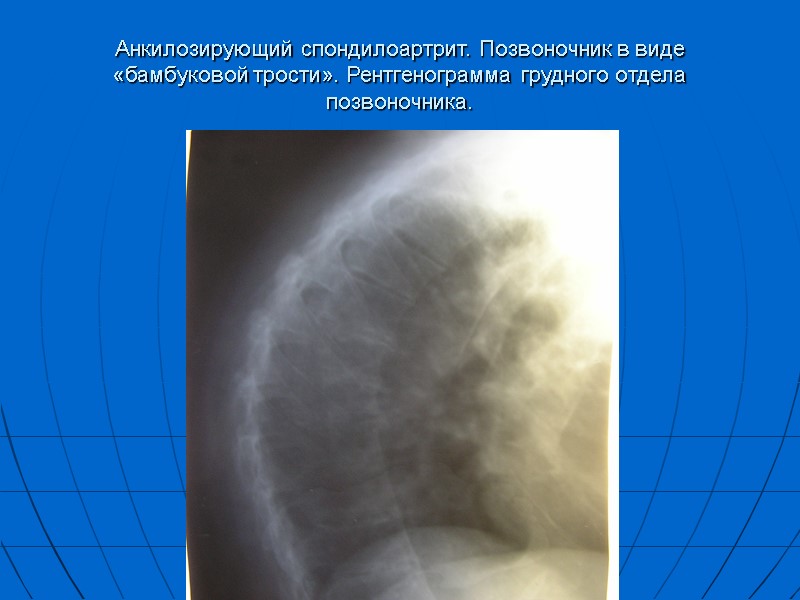 Анкилозирующий спондилоартрит. Позвоночник в виде «бамбуковой трости». Рентгенограмма грудного отдела позвоночника.